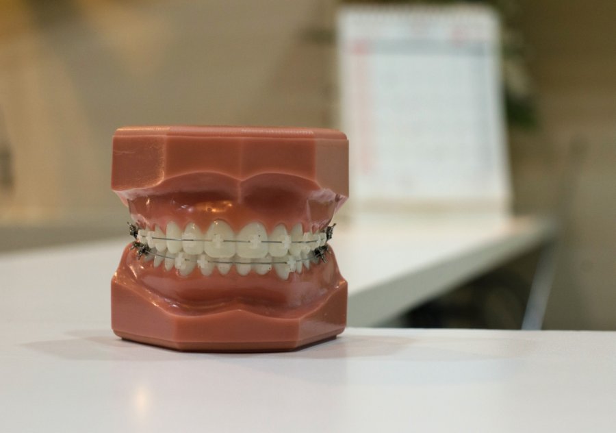 Aparaty ortodontyczne estetyczne. Czy warto? Ile kosztują?