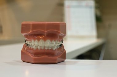 Aparaty ortodontyczne estetyczne. Czy warto? Ile kosztują?