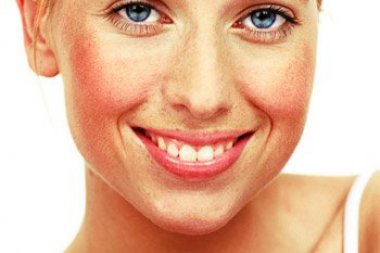 Laserowe usuwanie zmian naczyniowych na twarzy