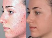 Promocja  peeling PQ-Age w bielsku Nails & lashes